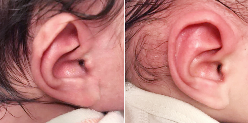 Ear molding: Before (left) and after images