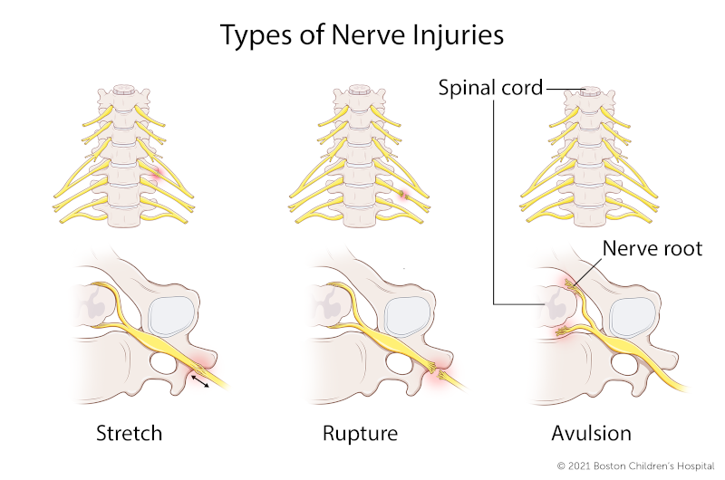 In a stretch brachial plexus injury, the nerve has been stretched, but not torn. In a rupture brachial plexus injury, the nerve has been torn, but remains attached to the spinal cord. In an avulsion brachial plexus injury, the nerve root has separated from the spinal cord.