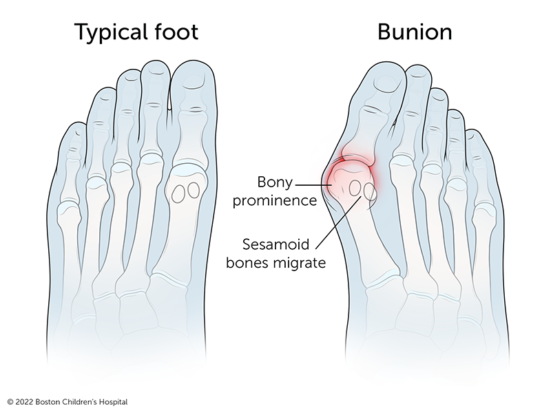 Illustration of a bunion