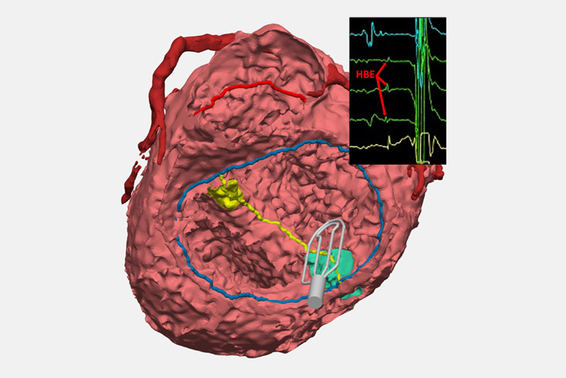 Illustration of electrophysiology catheter