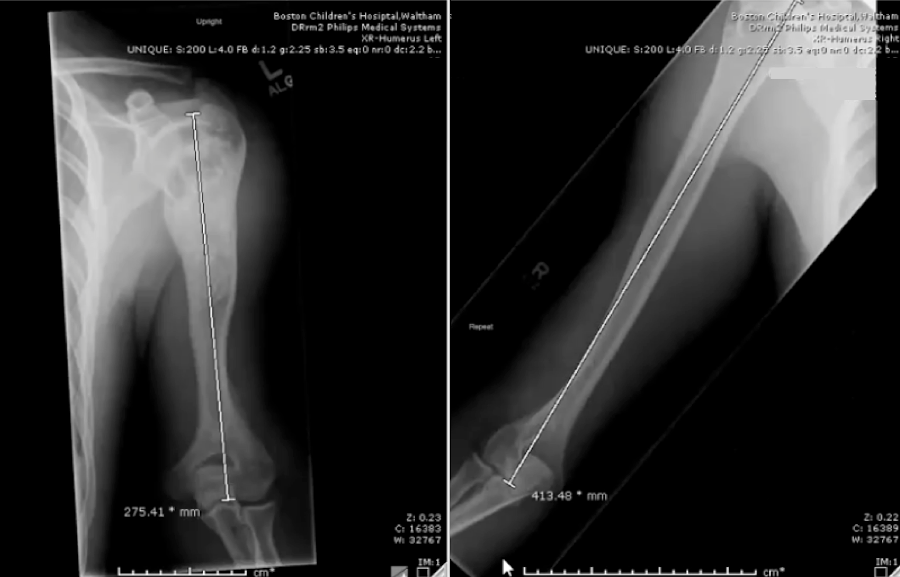 Two x-ray images of a patient’s left arm at two stages of arm lengthening. In the first, a lengthening rod has been surgically attached to the bone in the upper arm. In the second, the bone has been cut and there is a space between the ends of bone that the rod is supporting. New bone growth is visible in this space.