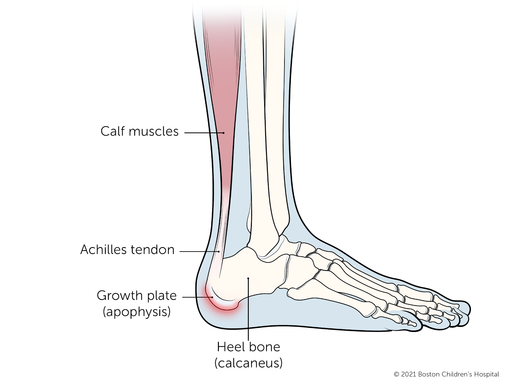 Illustration of Sever's disease