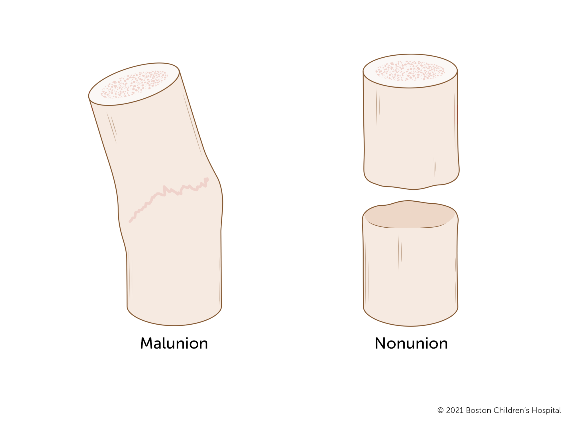 A malunion fracture that has healed at an angle and a nonunion that has not healed.