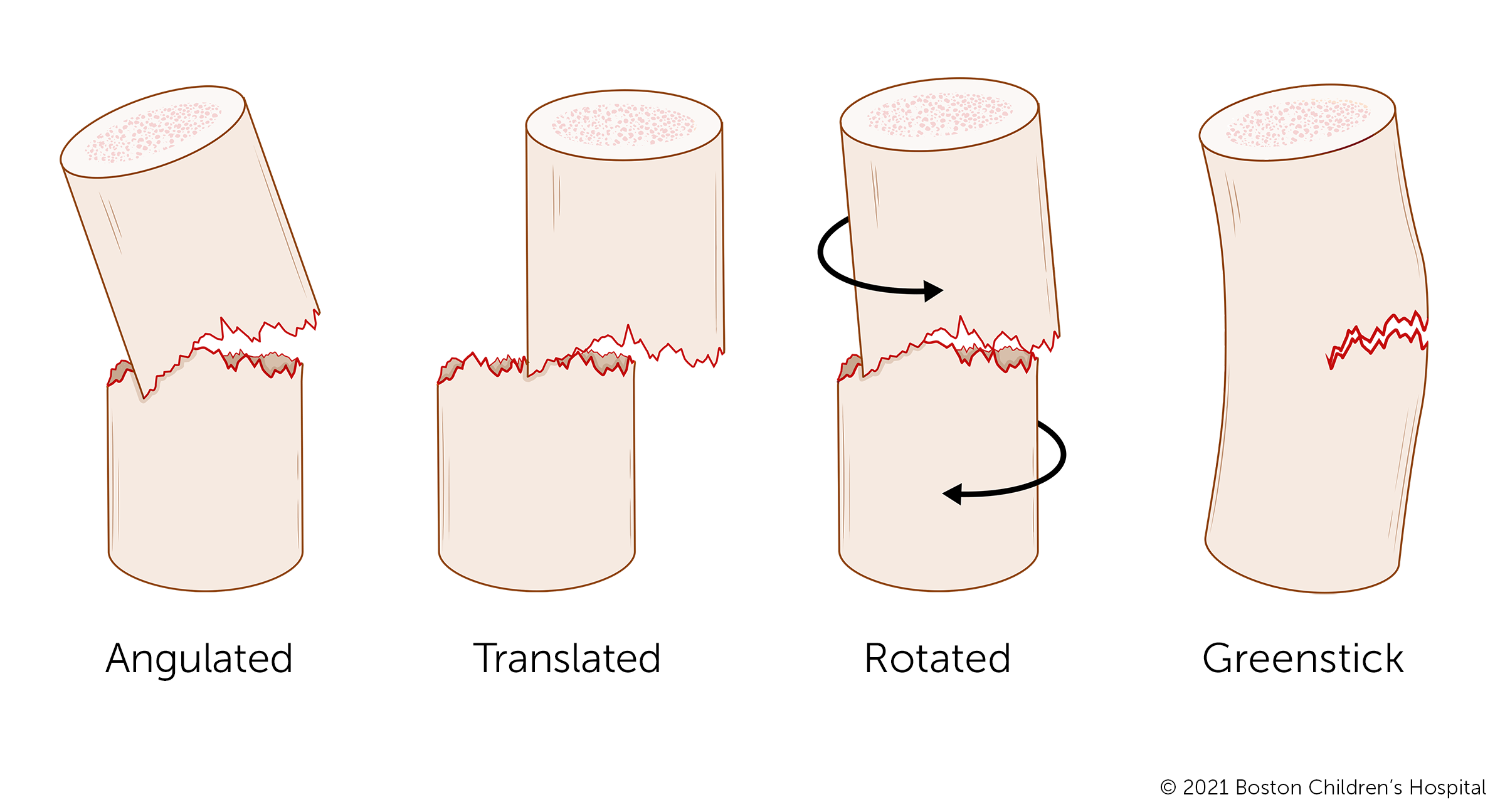 An illustration of displaced fractures