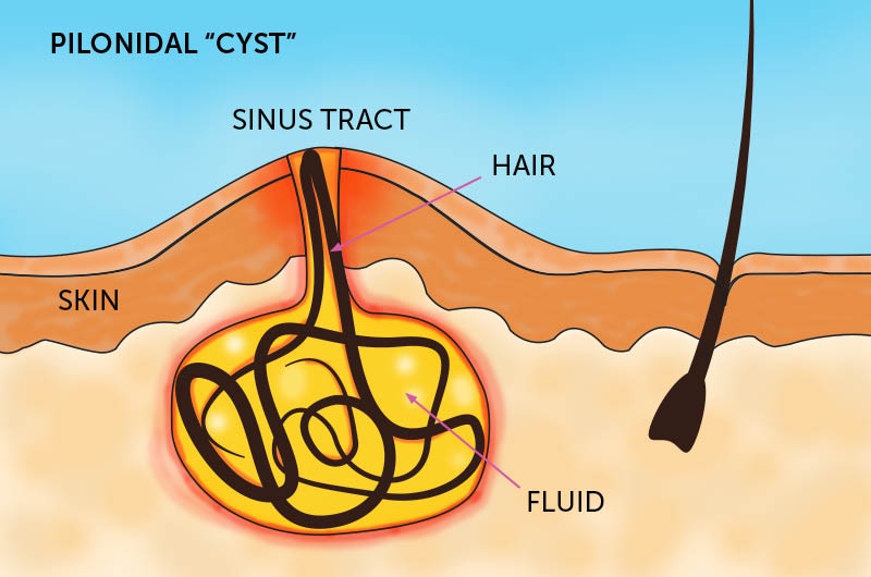 Pilonidal "Cyst"