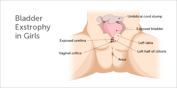 Image: Bladder exstropy in girls