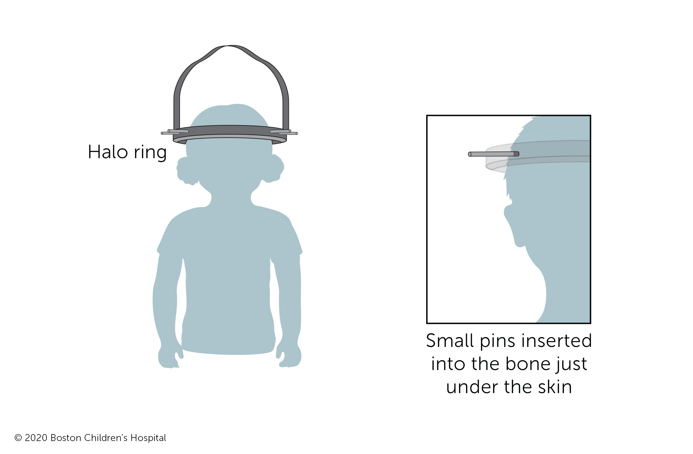 At the start of halo traction treatment, a metal halo is attached to a child’s skull with small pins inserted into the bone just under the skin.