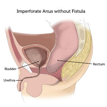 Imperforate Anus