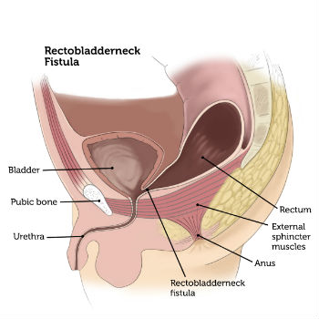 Rectobladderneck Fistula