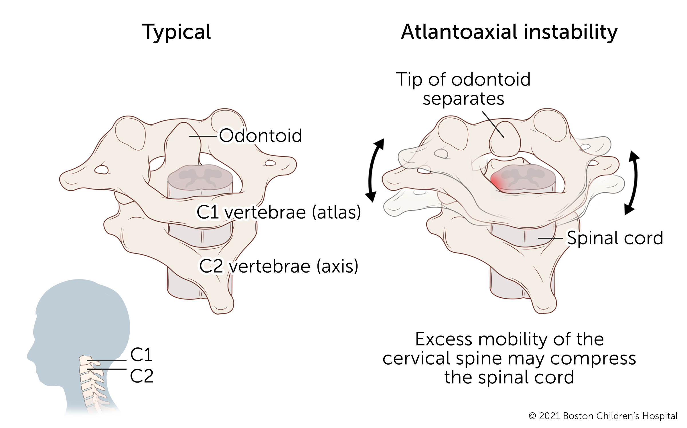 The cervical spine is made up of bones called vertebrae. Os odontoideum occurs when the tip of the second cervical vertebra separates from the rest of the bone.