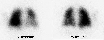 An image from a pulmonary blood flow scan.