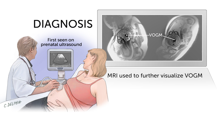 Vein of Galen Malformation (VOGM) Diagnosis