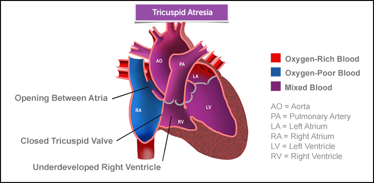 tricuspid atresia illustration